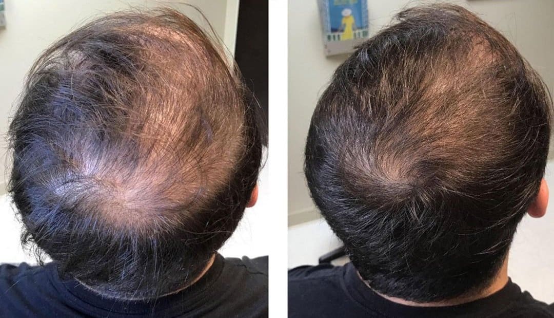 Hair Restoration Treatment | Artisan Aesthetics | Ajax, ON | Port Hope, ON