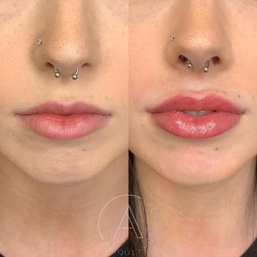 Lips Enhancement | Artisan Aesthetics | Ajax, ON | Port Hope, ON