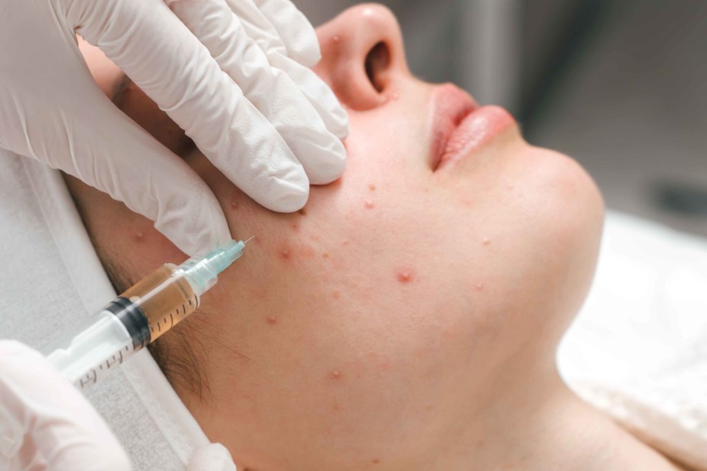 Treatment for Pimples | Artisan Aesthetics | Ajax, ON | Port Hope, ON