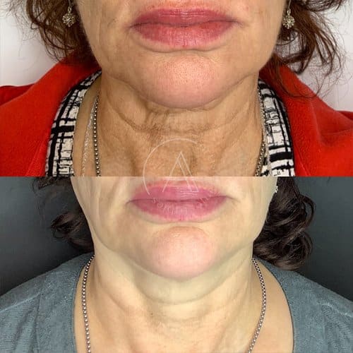 Before and After Neck Lift Treatment | Artisan Aesthetics | Ajax, ON | Port Hope, ON