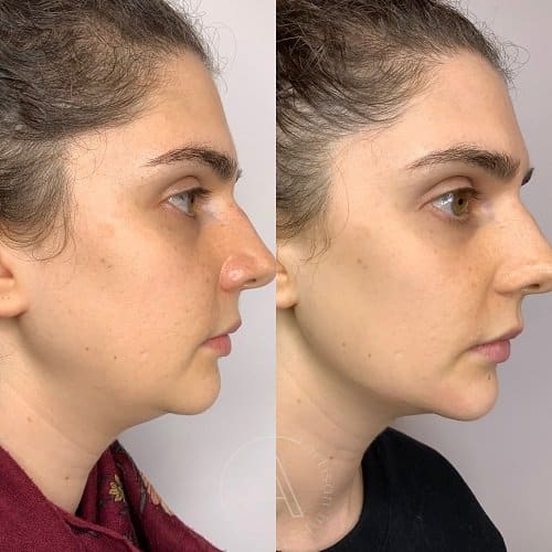 Lower Face Treatment | Artisan Aesthetics | Ajax, ON | Port Hope, ON